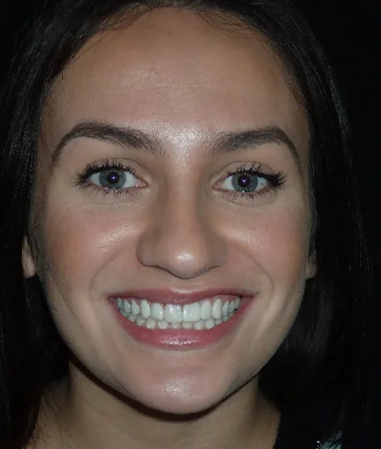 The same patient with their implant and new crown