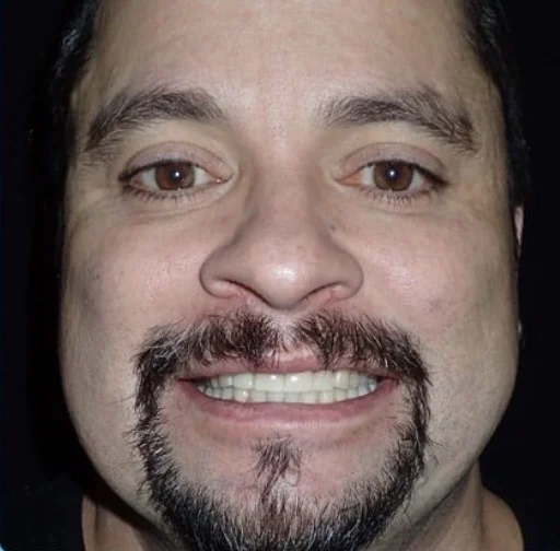 The same patient with their implant and new crown