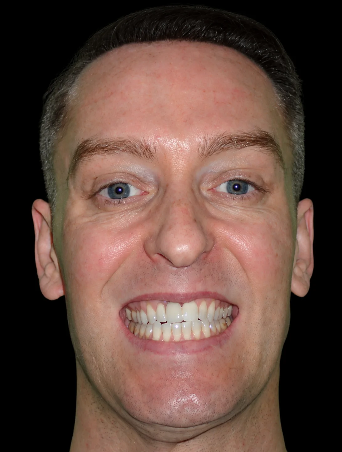 The same patient with their implant and new crown