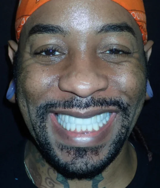 The same patient with their implant and new crown