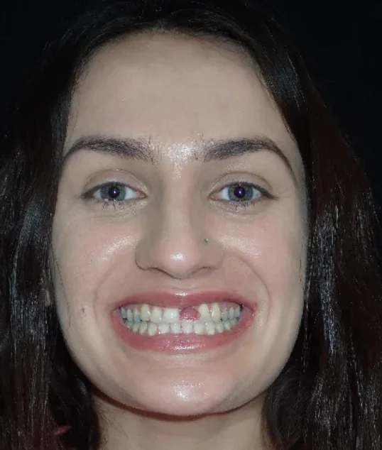 Patient before their single implant