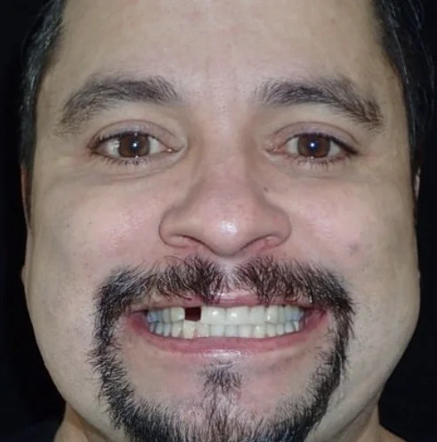 Patient before their single implant