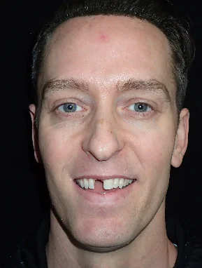 Patient before their single implant